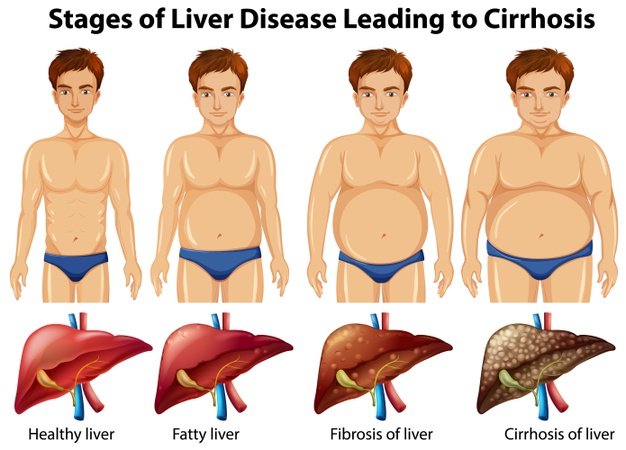 stages-liver-disease-leading-cirrhosis_1308-50312.jpg